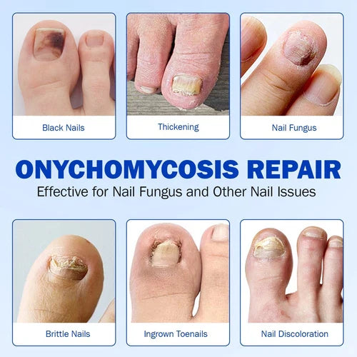 Fungal Nail Treatment 10 Patches