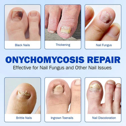 Fungal Nail Treatment 10 Patches