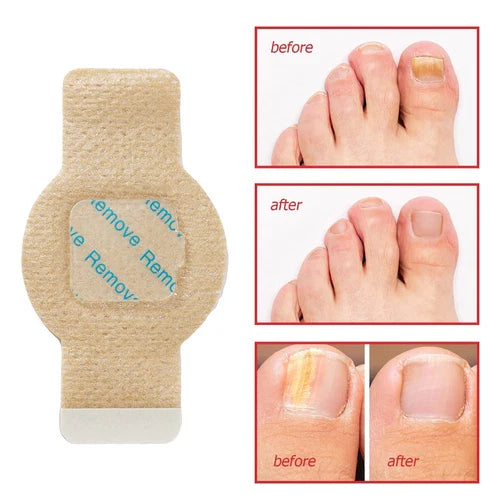Fungal Nail Treatment 10 Patches