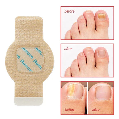 Fungal Nail Treatment 10 Patches